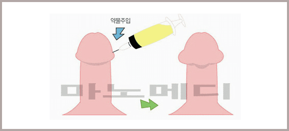 귀두 테두리 아래에 주사기로 약물을 주입해 귀두가 커지는 전후를 그린 그림