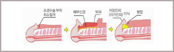 포경수술 부위를 최소절개하고, 배부신경 위 박피한 공간에 저장진피(자가진피)를 이식한 뒤 봉합하는 세 단계를 그린 그림