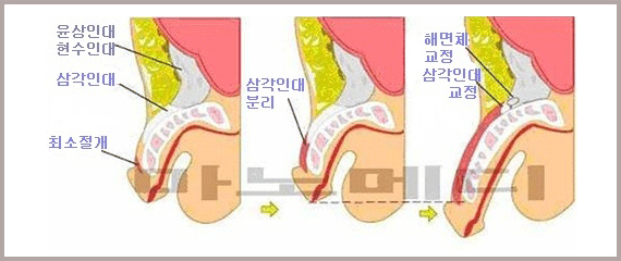 최소절개로 들어가 삼각인대를 분리하고, 윤상인대·현수인대는 남긴 채 해면체와 삼각인대를 교정하는 세 단계를 그린 그림