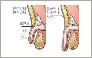 윤상인대·현수인대·해면체·고환·요도의 위치를 표시한 단면과, 윤상인대·현수인대를 차단한 뒤의 단면을 나란히 그린 그림