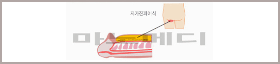 엉덩이 주름진 부위에서 떼어낸 자가 진피지방을 음경에 이식하는 위치를 그린 그림