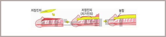 저장진피를 음경 부위에 얹고 자가진피로 자리잡게 한 뒤 봉합하는 세 단계를 그린 그림