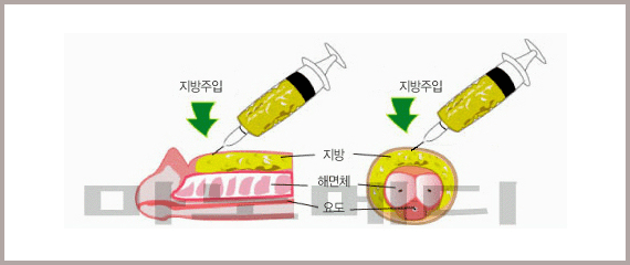 지방을 주사기로 음경에 주입하는 모습을 옆면과 단면으로 그린 그림