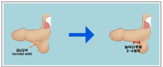 음낭갈퀴(scrotal web)가 있는 상태와 교정으로 2~4센치가 늘어난 상태를 화살표로 이어 견준 그림