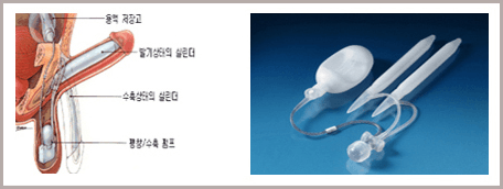 팽창형 보형물의 용액 저장고·실린더·펌프 위치를 그린 그림과 제품 사진