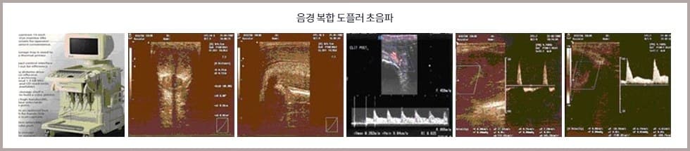 음경 복합 도플러 초음파 장비와 검사 화면 여섯 장을 이어 붙인 사진