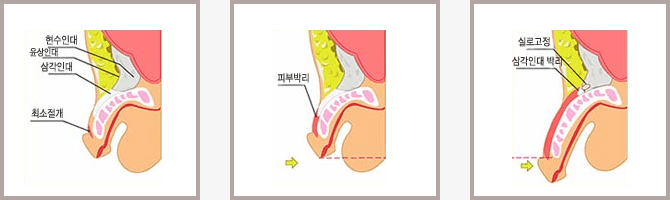 최소절개로 현수인대·윤상인대·삼각인대 위치를 잡고, 피부박리를 거쳐 실로 고정하며 삼각인대를 박리하는 세 단계를 그린 그림