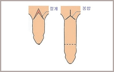 음경 표피를 V자로 절개한 모습과 Y자로 봉합한 모습을 나란히 그린 그림